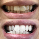 Stylo magique dents blanches